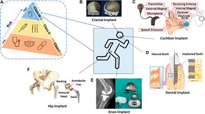 Surface Treatment and Bioinspired Coating for 3D-Printed Implants